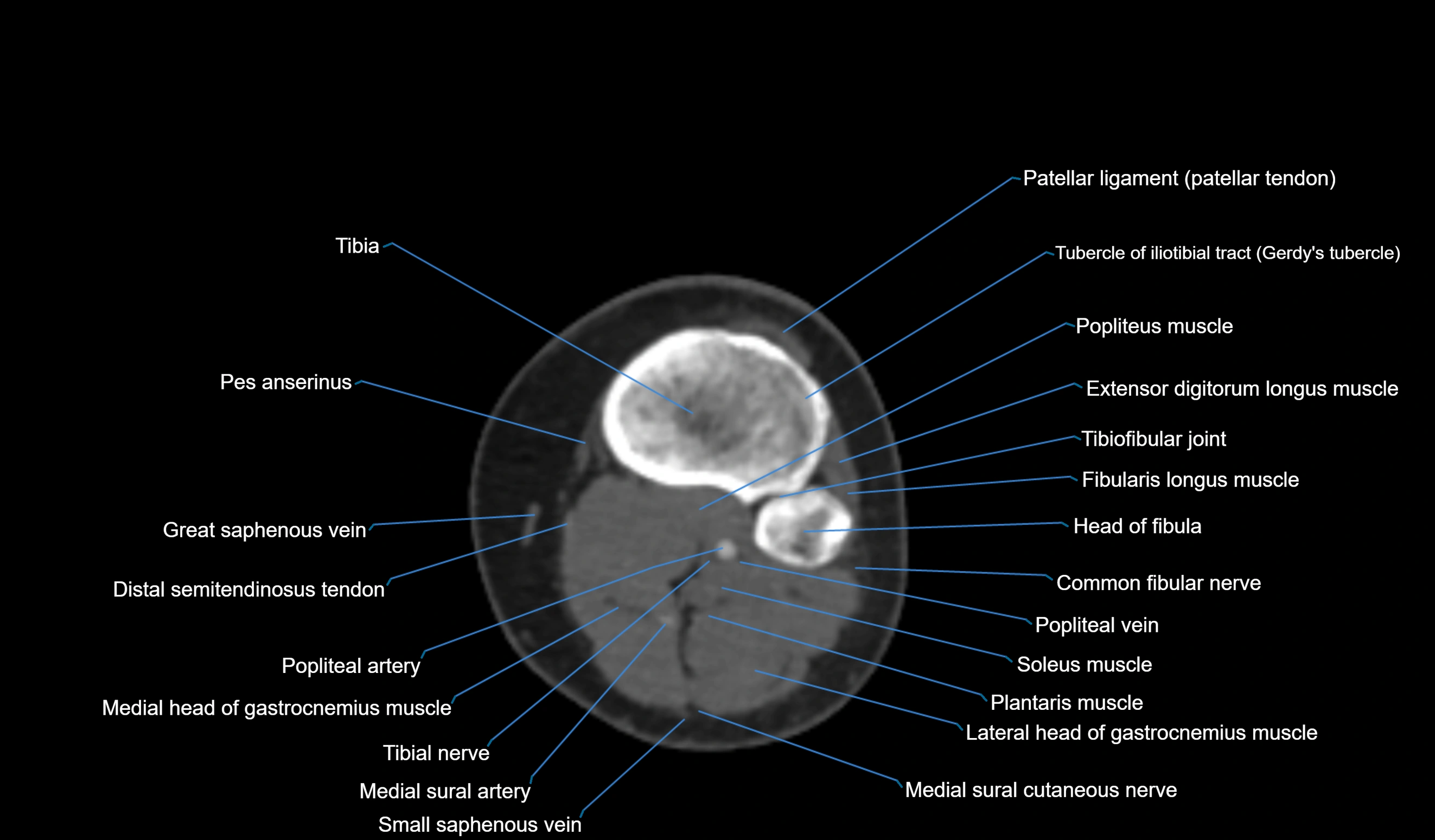 CT knee axial cross sectional anatomy labelled image-00045.webp
